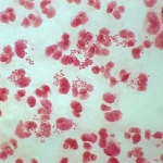 Il ruolo degli antisettici nel trattamento della gonorrea