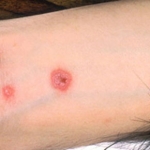 Glucocorticoidi e ciclosporina per la sindrome di Stevens-Johnson