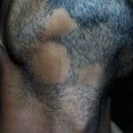 Alopecia areata della barba 