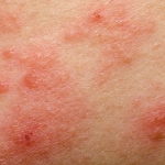 Inibitore di IL-31 si rivela efficace contro la dermatite atopica