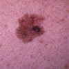 Il poliomavirus delle cellule di Merkel e HPV-17 associato al carcinoma cutaneo a cellule squamose sono comparsi in una paziente con melanoma trattata con l'inibitore di BRAF, dabrafenib