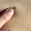 La sensibilità verso l'identificazione del melanoma è più alta con le immagini dermoscopiche rispetto alle fotografie cliniche