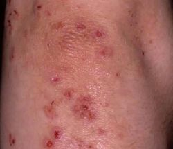 dermatitis-herpetiformis