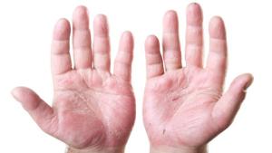 dermatitis-from-an-occupational