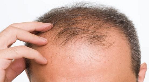 alopecia male head 3