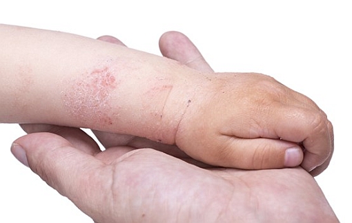 eczema paziente pediatrico
