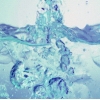 Iniezione a livello del derma superficiale di fillers dei tessuti molli con acido ialuronico: studio ecografico comparativo