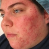 Effetto adiuvante dell'antistaminico nel trattamento dell'acne con isotretinoina: uno studio comparativo, randomizzato e controllato