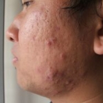 L'epigallocatechina-3-gallato migliora l'acne nell'uomo attraverso la modulazione di bersagli molecolari intracellulari e l'inibizione di P. acnes