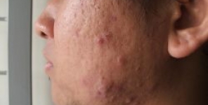 L'epigallocatechina-3-gallato migliora l'acne nell'uomo attraverso la modulazione di bersagli molecolari intracellulari e l'inibizione di P. acnes