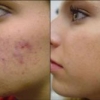 Trattamento delle cicatrici atrofiche del viso provocate dall'acne vulgaris, con laser Q-Switched Nd:YAG (neodimio: ittrio-alluminio-granato) a lunghezza d'onda di 1064 nm