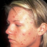 Isotretinoina 5 mg al giorno per l'acne volgare di basso grado negli adulti: uno studio randomizzato, in doppio cieco e controllato con placebo