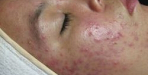 Microsfere gel di tretinoina per il trattamento dell'acne nei pre-adolescenti: uno studio randomizzato e controllato