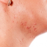 FDA approva Epiduo Forte Gel per il trattamento dell'acne 