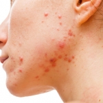 Dermatologi canadesi propongono nuove linee guida per l'acne