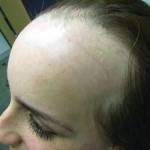 Carenza di vitamina D nell'alopecia areata