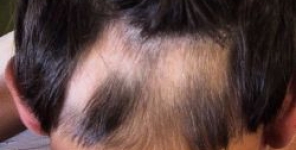 I retinoidi endogeni nella patogenesi dell'alopecia areata