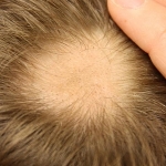 Risultati promettenti per l'alopecia areata con inibitori JAK