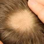 La terapia combinata è utile nei casi di alopecia refrattaria
