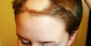 Effetto inibitorio della tianeptina sull'induzione del catagen nelle lesioni simili all'alopecia areata indotte dalle onde ultrasoniche nei topi