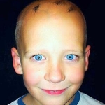 Caratteristiche cliniche dell'alopecia infantile indotta dalla chemioterapia