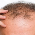Genetica e alopecia androgenetica
