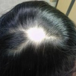Chemochina sierica del timo regolante l'attivazione: un biomarcatore dell'attività e della risposta nell'alopecia areata