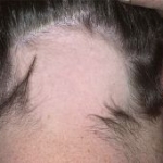 IL-2RA e il locus TNF/LTA sono fattori di rischio per l'alopecia areata grave