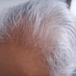 Uno studio su efficacia e la sicurezza di dutasteride confrontata e finasteride per il trattamento dei soggetti maschi con alopecia androgenetica