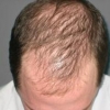 L'alopecia androgenetica e il rischio di cancro alla prostata: una revisione sistematica e una meta-analisi