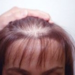 Distruzione del muscolo erettore del pelo e infiltrazione di grasso nell'alopecia androgenetica