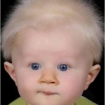 I capelli dei neonati e dei lattanti: valutazione clinica e dermoscopica di 45 casi