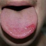 L'uso di inibitori selettivi della ricaptazione della serotonina nel trattamento della sindrome della bocca che brucia