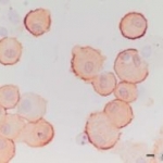 Associazione tra il numero di cellule CD163+ nella cute lesionata e i livelli sierici di CD163 solubile