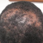 Ereditarietà autosomica dominante dell'alopecia cicatriziale centrale centrifuga nei soggetti neri sudafricani