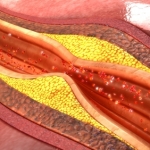 Pazienti con psoriasi: aumenta il rischio di placche coronariche