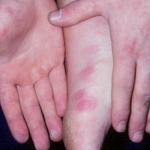 Malattia mani-piedi-bocca indotta dal coxsackie virus A6