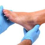 Staminali riducono del 50% le ulcere da piede diabetico