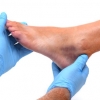 Staminali riducono del 50% le ulcere da piede diabetico
