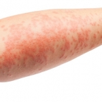 FDA approva il crisaborolo per il trattamento della dermatite atopica