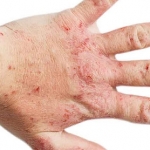 Dupilumab promettente per la dermatite atopica
