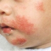 Terapia con medicazioni umide e corticosteroidi efficace per il controllo della dermatite atopica pediatrica