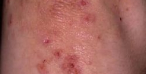 Casi di dermatite erpetiforme che non mostrano sintomi intestinali o immunoglobuline A contro antigeni noti