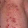 Casi di dermatite erpetiforme che non mostrano sintomi intestinali o immunoglobuline A contro antigeni noti