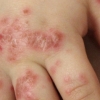 Il pimecrolimus nel trattamento dell'eczema: nessun rischio cancerogeno?