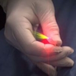 L'ablazione laser endovenosa delle vene perforanti incompetenti con fibra radiale da 1470 nm e 400 μm