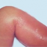 Incidenza di trombosi venosa profonda nell'erisipela o nella cellulite degli arti inferiori