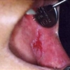 Pimecrolimus vs. tacrolimus per il trattamento topico del lichen planus orale erosivo non responsivo: uno studio di 8 settimane, randomizzato, in doppio cieco e controllato