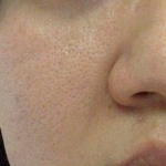 Valutazione dei pori del viso e della struttura della pelle dopo alcuni trattamenti con laser frazionato, non ablativo, a bassa energia e a 1440-nm