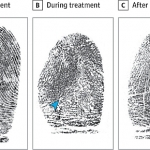 Impronte digitali e terapia con capecitabina